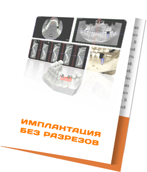 Имплантация без разрезов